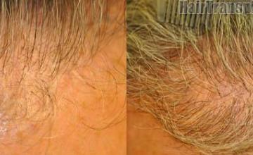 Closeup view of hair restoration procedure hairline