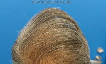 Hair restoration procedure before and after pictures