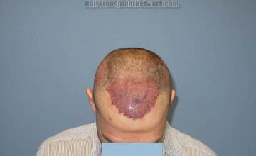 Hair transplantation surgery before and after pictures