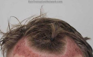 Hair restoration surgery before and after photos