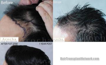 Hair transplantation surgery before and after pictures