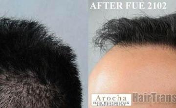 Hair transplantation surgery before and after images