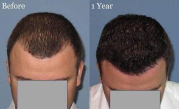 Top view before and after hair restoration results