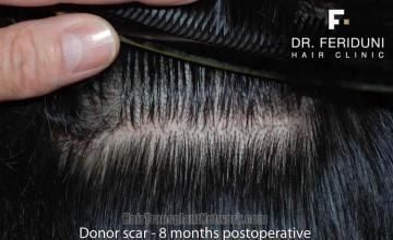 Residual donor scar 8 months after hair transplant