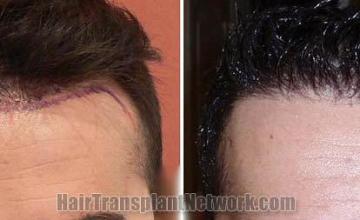 Hair restoration procedure before and after results