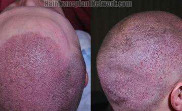 Hair transplant surgery before and after photos