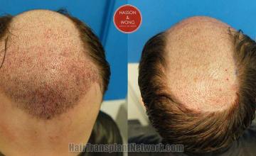 Hair restoration procedure before and after pictures