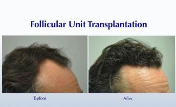 Hair restoration procedure before and after results