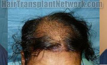 Top view - Before and after hair restoration procedure