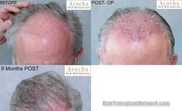 Hair restoration procedure before and after pictures