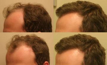 Hair transplantation surgery before and after images