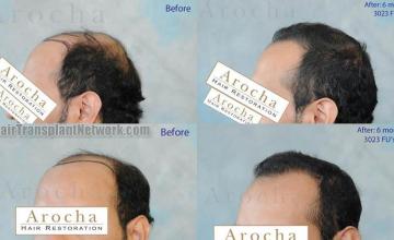 Hair transplantation surgery before and after pictures