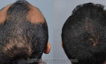 Hair restoration procedure before and after pictures