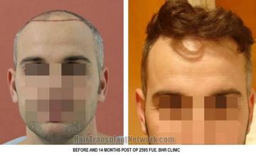 Hair restoration procedure before and after results