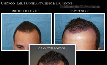 Hair restoration procedure before and after results