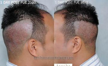 Hair transplantation surgery before and after pictures