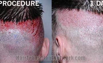 Hair transplantation surgery before and after pictures