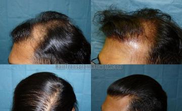 Left view before and after hair transplantation