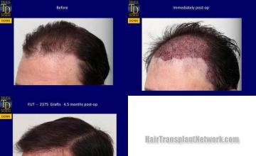 Hair transplantation surgery before and after pictures