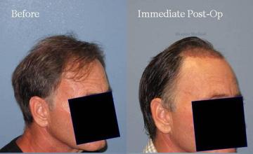 Before and after surgical hair restoration images