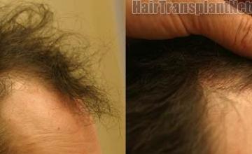 Hair restoration procedure before and after results