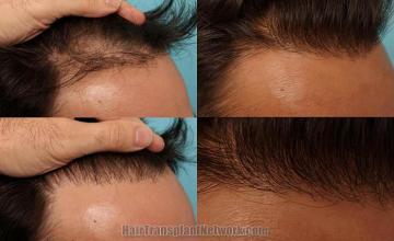 Hair transplantation surgery before and after images