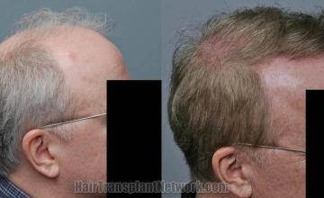 Hair transplantation surgery before and after photos