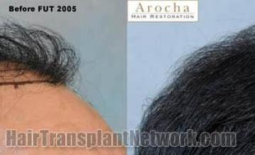 Hair transplantation surgery before and after photos