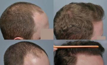 Hair transplantation surgery before and after images