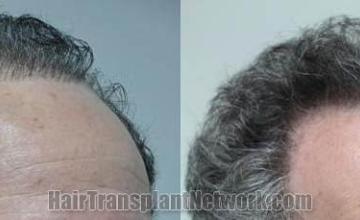 Hair transplantation surgery before and after images