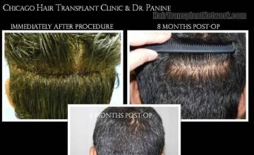 Hair restoration procedure results