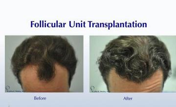 Before and after hair transplant procedure images