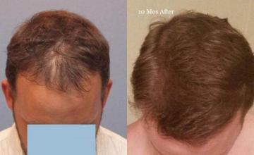 Hair transplantation surgery before and after photos