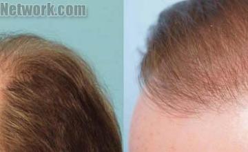 Hair transplantation surgery before and after images