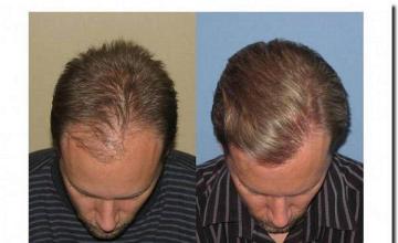 Hair restoration procedure results