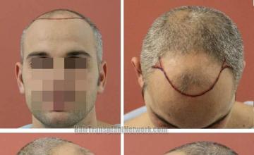 Hair transplantation surgery before photos