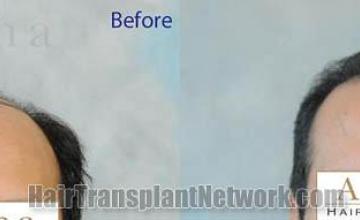 Hair restoration procedure before and after results