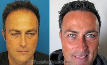 Before and after hair transplant procedure images