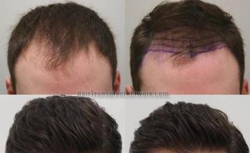 Hair restoration procedure before and after results