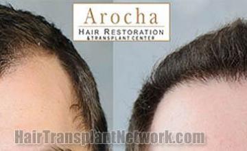 Hair transplantation surgery before and after photos