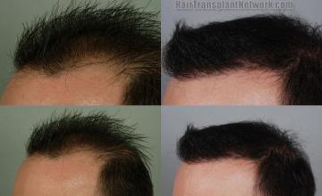 Photos of before and after hair transplantation surgery 