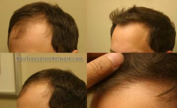 Hair transplantation surgery before and after pictures