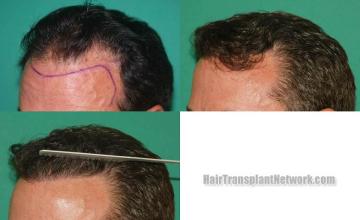 Hair restoration procedure before and after pictures