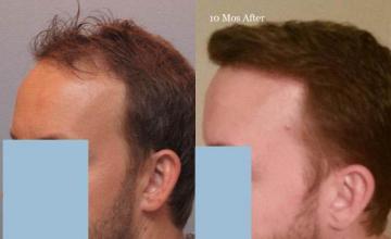 Hair transplantation surgery before and after pictures