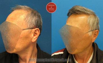 Hair transplantation surgery before and after pictures