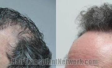 Hair transplantation surgery before and after pictures