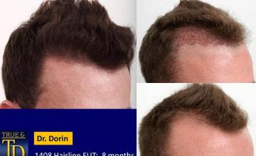 Hair restoration procedure before and after pictures