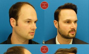 Hair restoration procedure before and after results