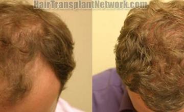 Top view before and after hair restoration results