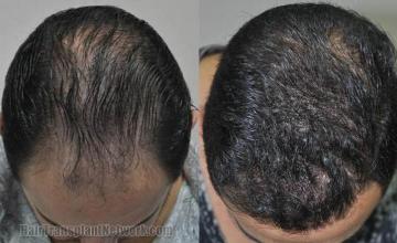 Hair restoration procedure before and after results